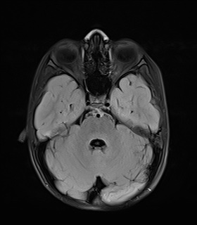 File:Bilateral mesial temporal polymicrogyria (Radiopaedia 76456-88181 Axial FLAIR 7).jpg