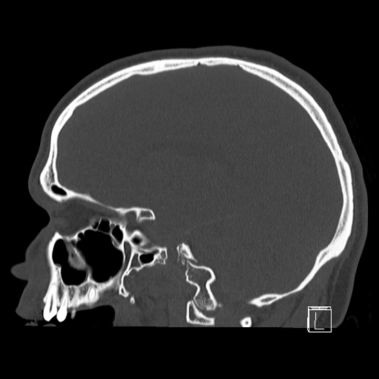 Bilateral occipital condyle fracture (type 2) (Radiopaedia 87675-104089 Sagittal bone window 42).jpg