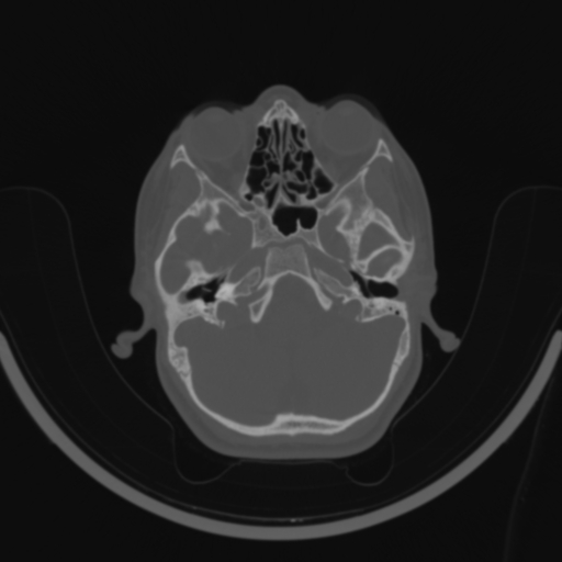 Bilateral otosclerosis (Radiopaedia 57237-64157 C 37).jpg