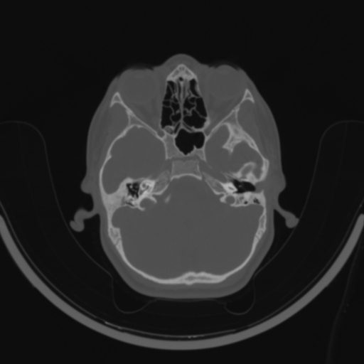 Bilateral otosclerosis (Radiopaedia 57237-64157 C 41).jpg