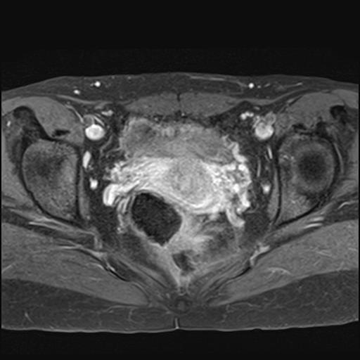 File:Bilateral ovarian endometriomas (Radiopaedia 87085-103347 Axial T1 C+ fat sat 14).jpg