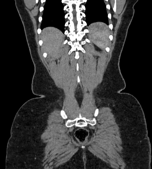 Bilateral ovarian mature cystic teratomas (Radiopaedia 79373-92457 B 99).jpg