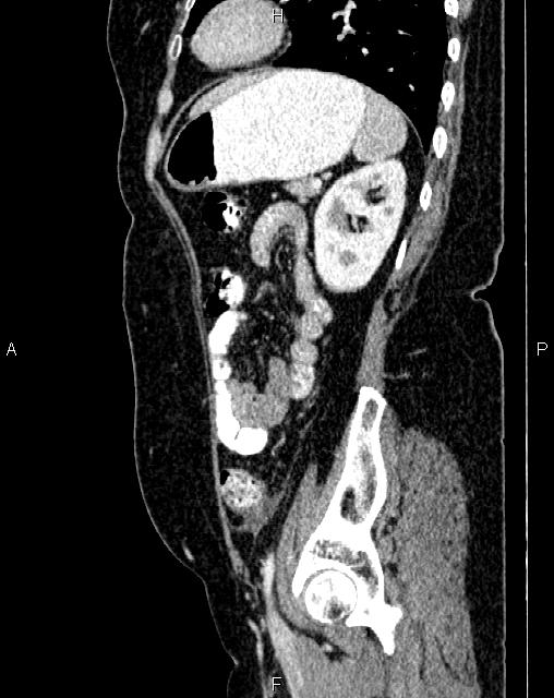 Bilateral ovarian serous cystadenocarcinoma (Radiopaedia 86062-101989 E 65).jpg