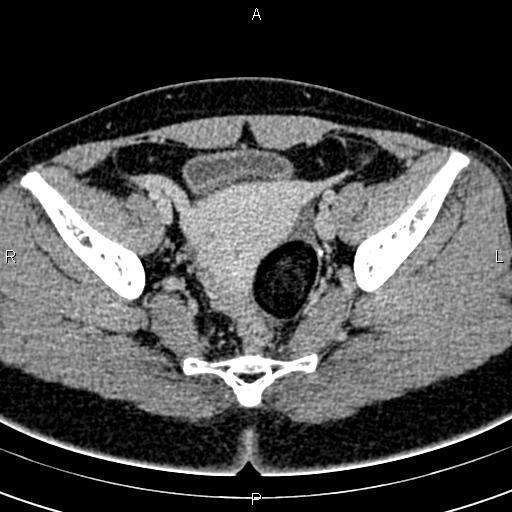 Bilateral ovarian teratoma (Radiopaedia 83131-97503 B 43).jpg