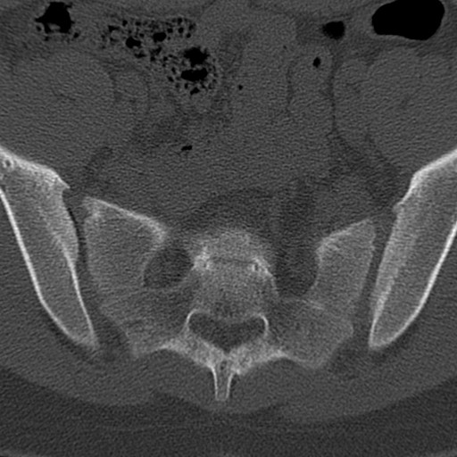 Bilateral pars defect (Radiopaedia 26691-26846 Axial bone window 97).jpg