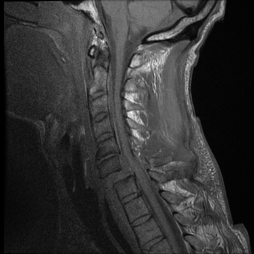 File:Bilateral perched facets with cord injury (Radiopaedia 45587-49714 Sagittal T1 7).jpg
