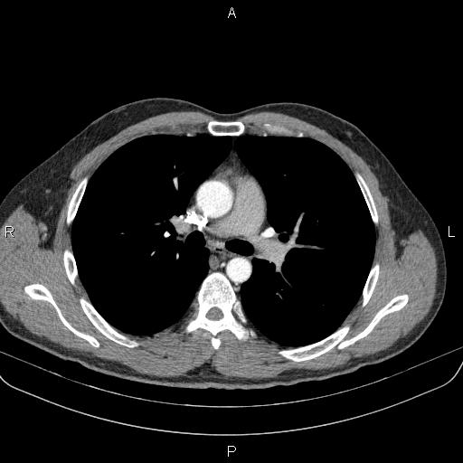 Bilateral pulmonary AVM (Radiopaedia 83134-97505 A 31).jpg