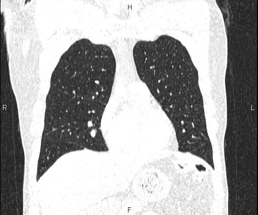 Bilateral pulmonary AVM (Radiopaedia 83134-97505 Coronal lung window 30).jpg