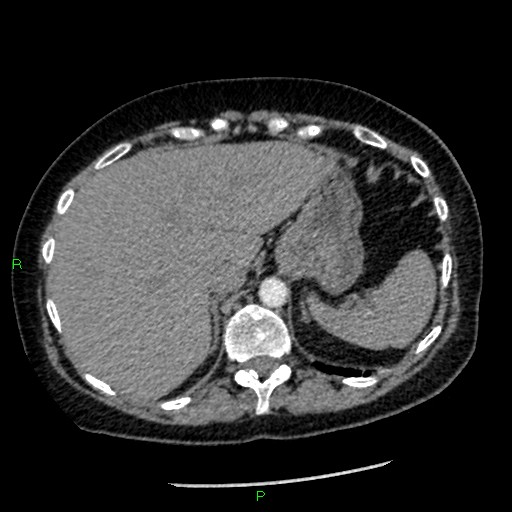 Bilateral pulmonary emboli (Radiopaedia 32700-33669 Axial C+ CTPA 99).jpg