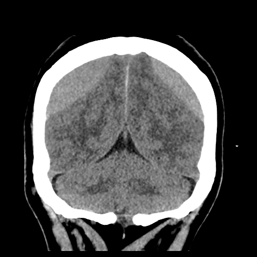 Bilateral subacute subdural hematoma (Radiopaedia 69240-79018 Coronal non-contrast 45).jpg