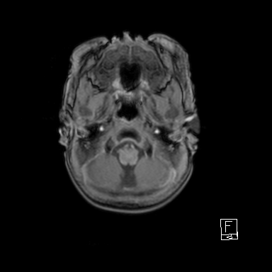 Bilateral subdural hemorrhage and parietal skull fracture (Radiopaedia 26058-26190 Axial T1 7).png