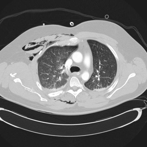 Bilateral traumatic renovascular injury (Radiopaedia 32051-32995 Axial lung window 19).jpg