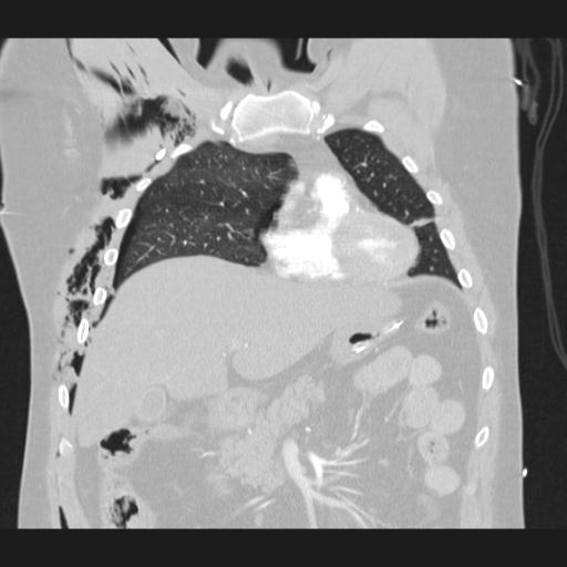 Bilateral traumatic renovascular injury (Radiopaedia 32051-32995 Coronal lung window 26).jpg