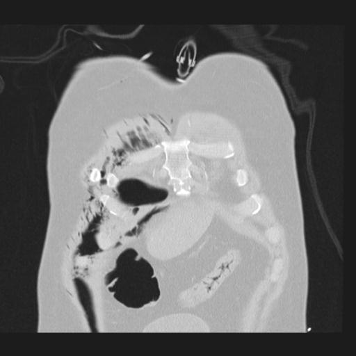 Bilateral traumatic renovascular injury (Radiopaedia 32051-32995 Coronal lung window 9).jpg