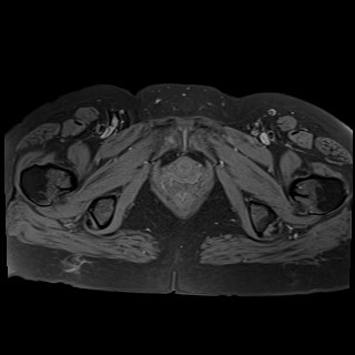 Bilateral tubo-ovarian abscesses (Radiopaedia 58635-65829 Axial T1 fat sat 41).jpg