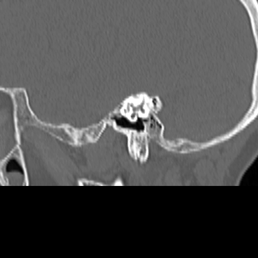 Bilateral tympanoplasty (Radiopaedia 16947-16664 Sagittal bone window 34).jpg