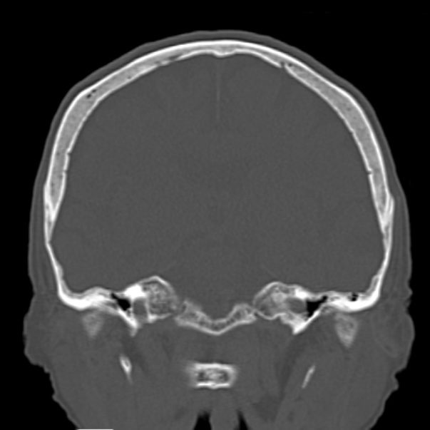 Biparietal osteodystrophy (Radiopaedia 46109-50463 Coronal bone window 57).jpg