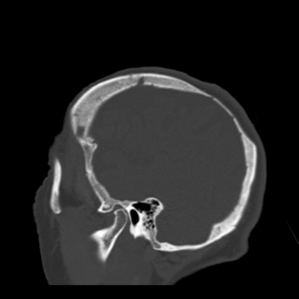 Biparietal osteodystrophy (Radiopaedia 46109-50463 Sagittal bone window 22).jpg