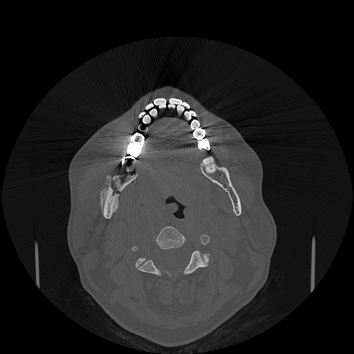 File:Bisphosphonate-related osteonecrosis of the jaw (Radiopaedia 71324-81642 Axial bone window 72).jpg