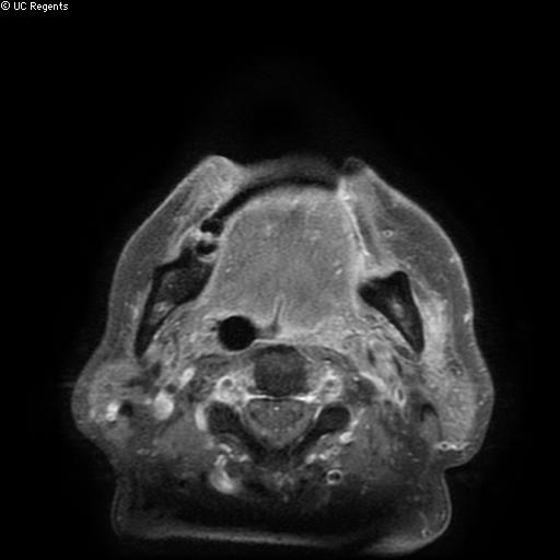 Bisphosphonate-related osteonecrosis of the maxilla (Radiopaedia 51367-57101 Axial T1 C+ fat sat 8).jpg