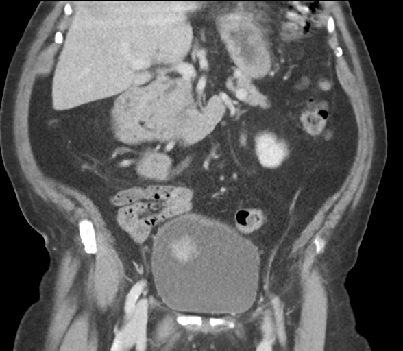 Bladder papillary urothelial carcinoma (Radiopaedia 48119-52951 C 33).png