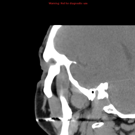 File:Blowout fracture with inferior rectus entrapment (Radiopaedia 12418-12673 C 1).jpg