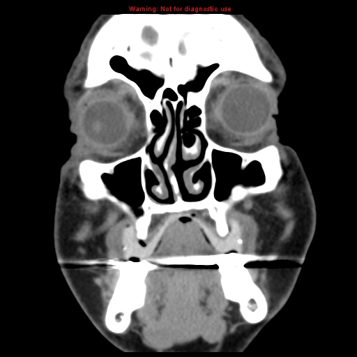 File:Blowout fracture with inferior rectus entrapment (Radiopaedia 12418-12673 Coronal non-contrast 3).jpg