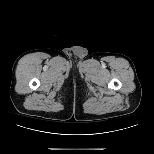 Blunt abdominal trauma with solid organ and musculoskelatal injury with active extravasation (Radiopaedia 68364-77895 A 181).jpg