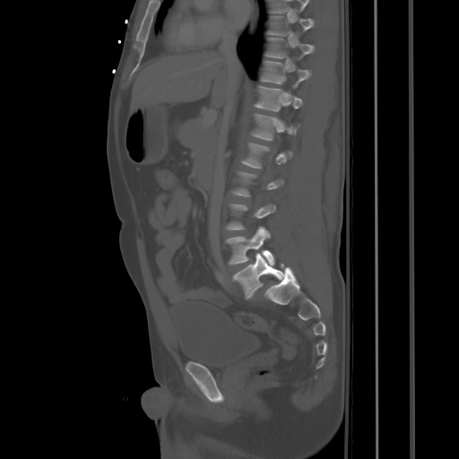 Blunt abdominal trauma with solid organ and musculoskelatal injury with active extravasation (Radiopaedia 68364-77895 Sagittal bone window 44).jpg