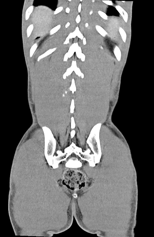 Blunt injury to the small bowel (Radiopaedia 74953-85987 B 82).jpg