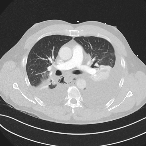 Boerhaave syndrome (Radiopaedia 39382-41660 Axial lung window 24).png