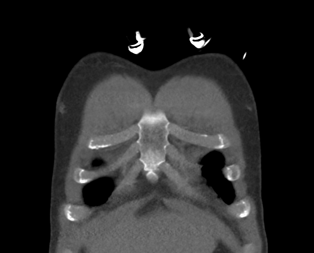 Boerhaave syndrome (Radiopaedia 39382-41660 C 13).png