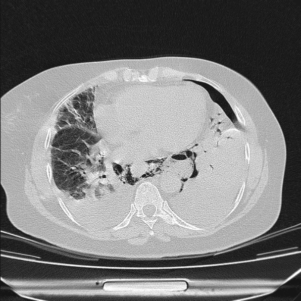 Boerhaave syndrome (Radiopaedia 45644-49799 Axial lung window 79).jpg