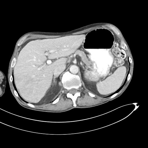 Bone metastasis from squamous cell carcinoma (Radiopaedia 30133-30730 B 18).jpg