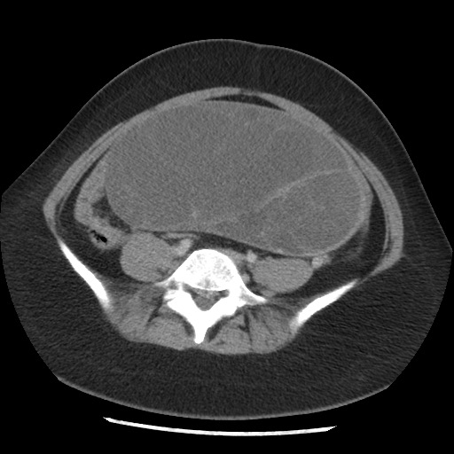 File:Borderline mucinous tumor (ovary) (Radiopaedia 78228-90808 A 107).jpg