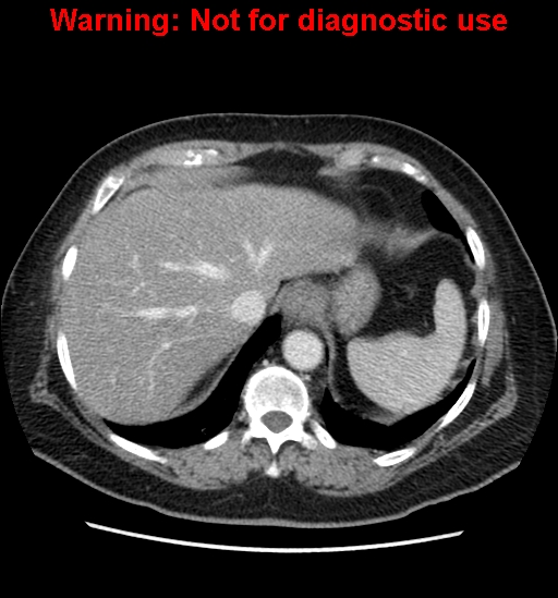File:Bosniak renal cyst - type II (Radiopaedia 23404-23468 D 13).jpg
