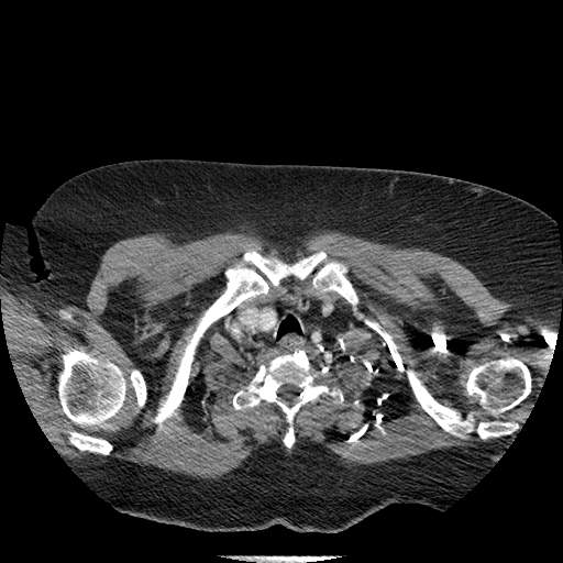 Bovine aortic arch - right internal mammary vein drains into the superior vena cava (Radiopaedia 63296-71875 A 5).jpg