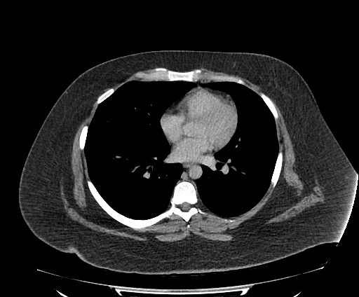Bowel and splenic infarcts in acute lymphocytic leukemia (Radiopaedia 61055-68913 A 5).jpg