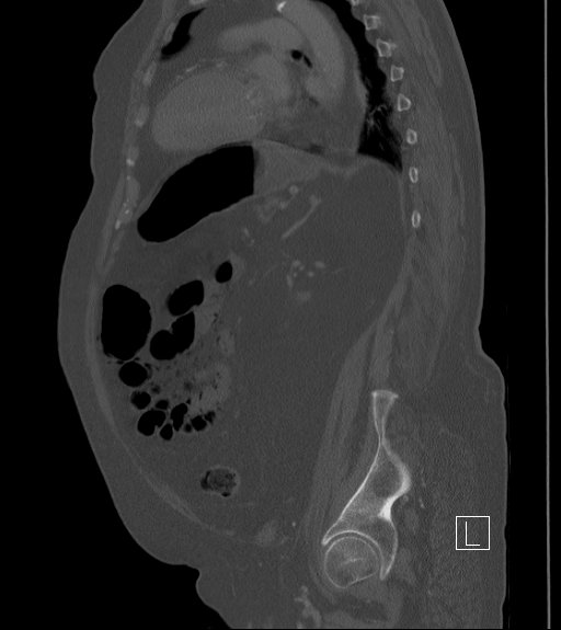 Bowel ischemia secondary to SMA occlusion with extensive portomesenteric venous gas (Radiopaedia 54656-60871 Sagittal bone window 35).jpg