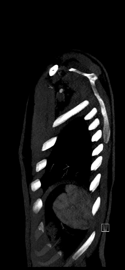 Brachiocephalic trunk pseudoaneurysm (Radiopaedia 70978-81191 C 84).jpg
