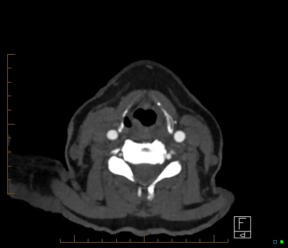 Brachiocephalic trunk stenosis (Radiopaedia 87242-103519 A 102).jpg