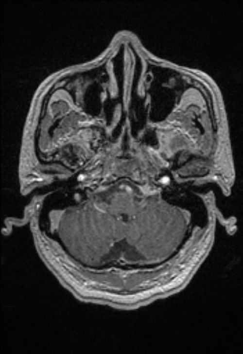 Brain abscess with ventriculitis (Radiopaedia 85703-101495 Axial T1 C+ 38).jpg