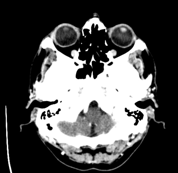 File:Brain metastases from lung cancer (Radiopaedia 24480-24781 Axial C+ delayed 5).jpg