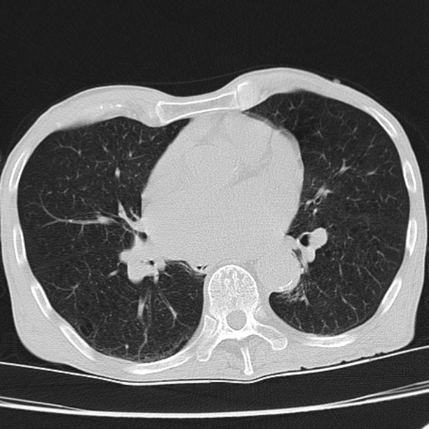 Brain metastases from lung cancer (Radiopaedia 27849-28093 Axial lung window 38).jpg