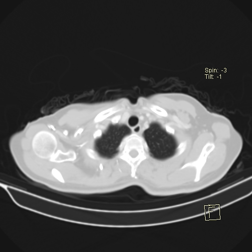 File:Brain metastasis as initial presentation of non-small cell lung cancer (Radiopaedia 65122-74127 Axial lung window 6).jpg