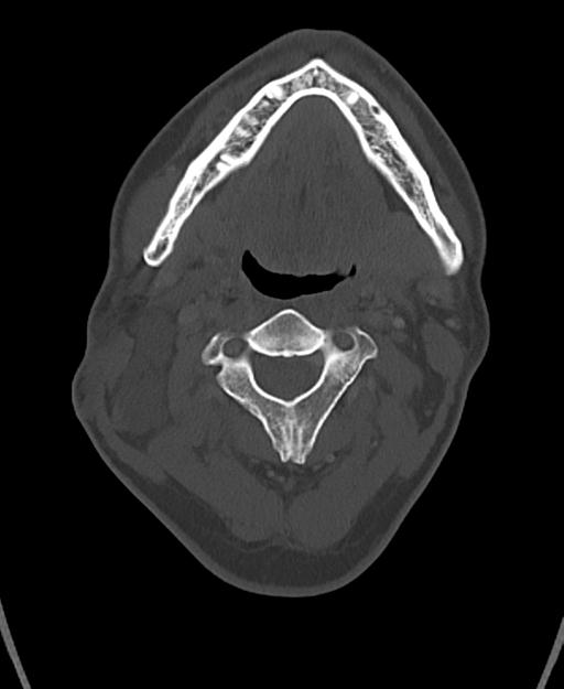 Branchial cleft cyst (Radiopaedia 31167-31875 Axial bone window 27).jpg