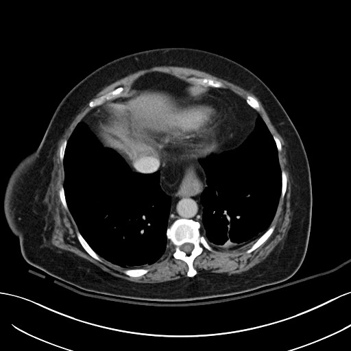 File:Breast carcinoma with pathological hip fracture (Radiopaedia 60314-67974 B 6).jpg