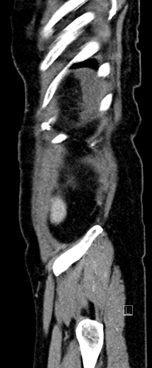 Broad ligament hernia (Radiopaedia 84802-100276 C 1).jpg
