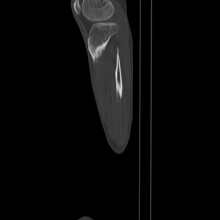 Brodie abscess - tibia (Radiopaedia 66028-75204 Sagittal bone window 67).jpg