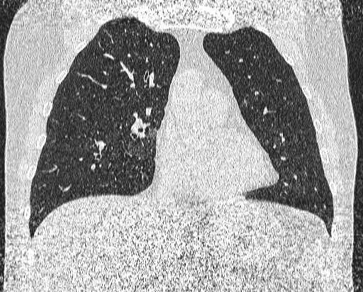 Bronchial atresia (Radiopaedia 58271-65417 Coronal lung window 20).jpg